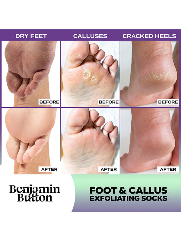 Benjamin Button Foot & Callus Exfoliating Socks (5pk)