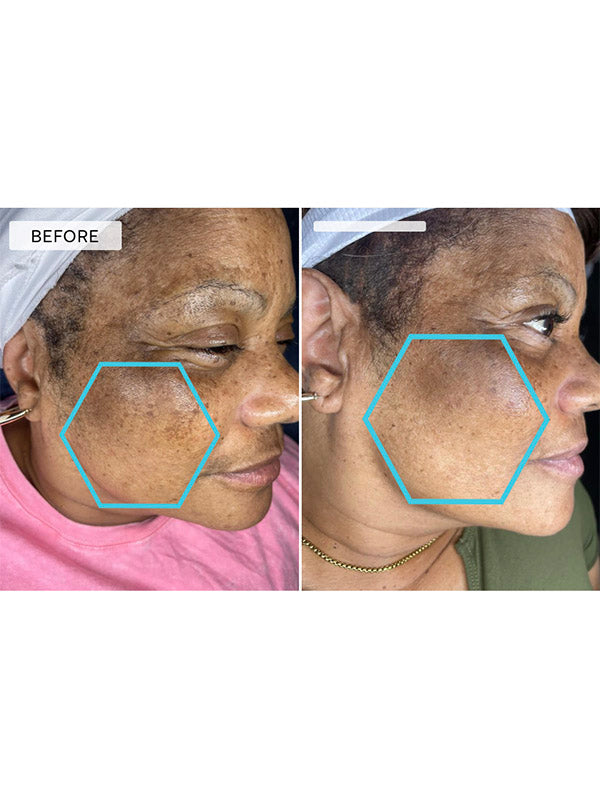 DermaQuest MelaQuest Facial Cleanser