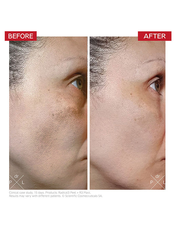 Dr. Levy Radical3 Reboot Pro Peel (50ml)